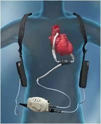 Left-Ventricular-Assist-Devices-