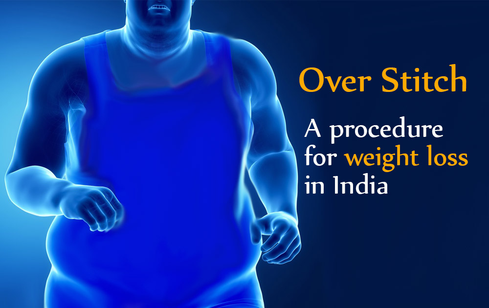Over stitch – weight lose device