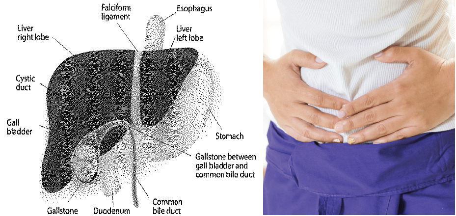 Gallstones