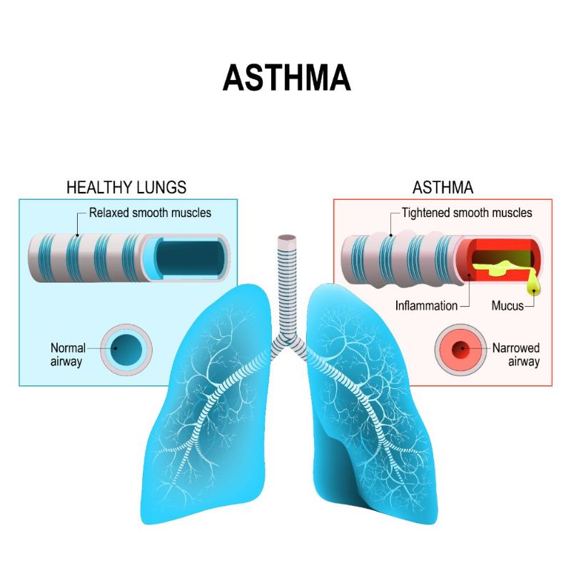 A myth buster on bronchial asthma and its treatment