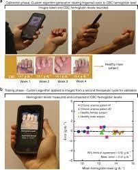 ‘Anemocheck’- a smartphone application for the non-invasive detection of anemia