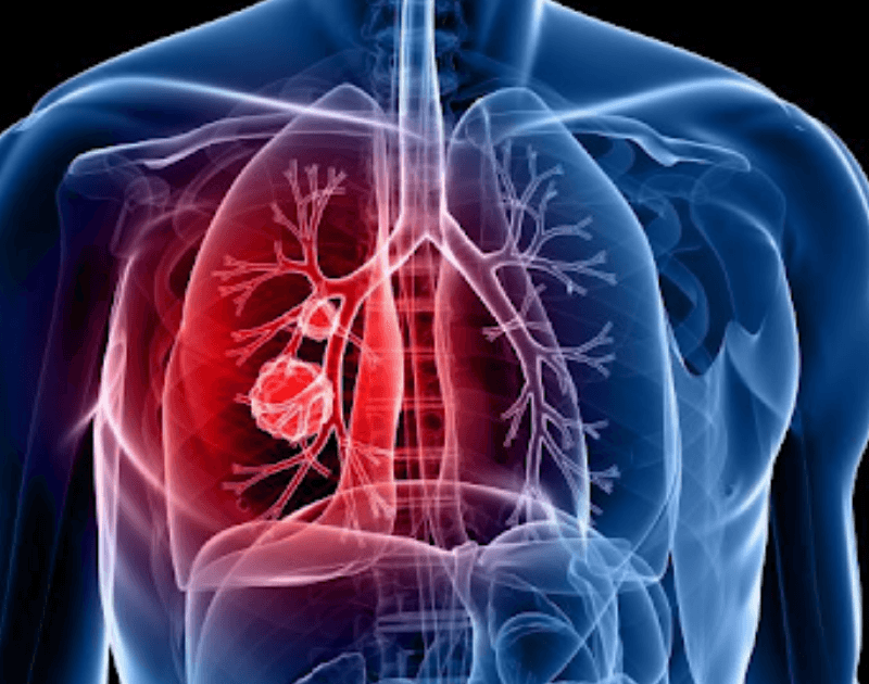 AI blood testing technology developed to detect lung cancers