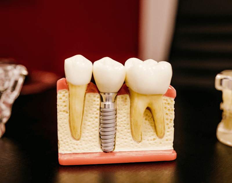Dental Biomaterials and its Market Growth