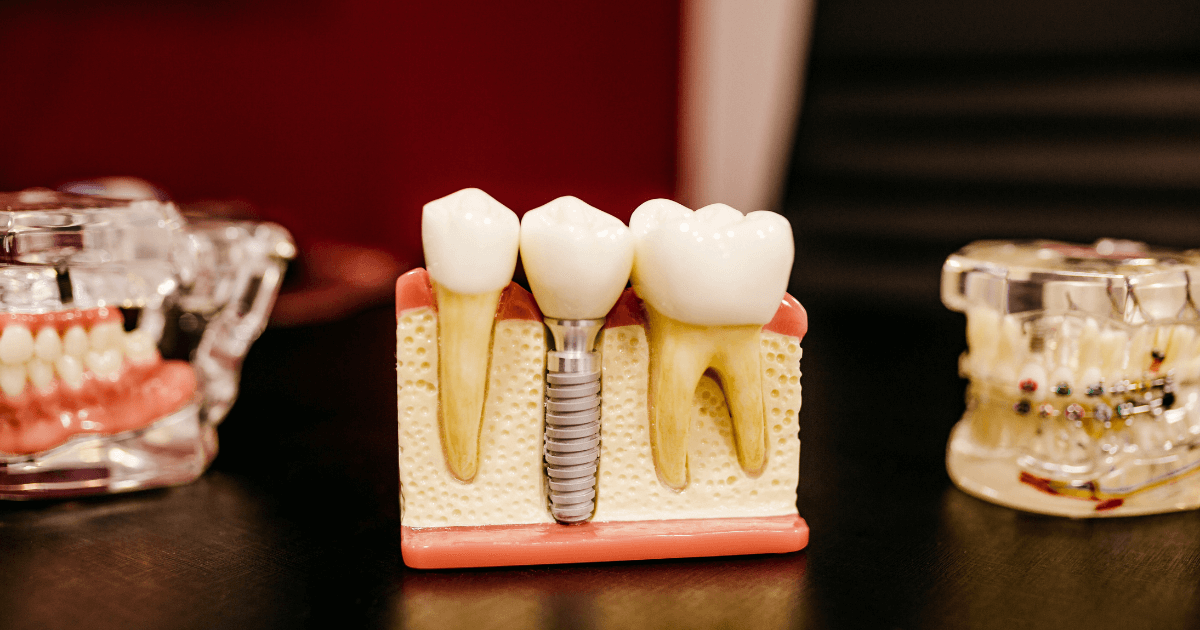 Dental Biomaterials and its Market Growth