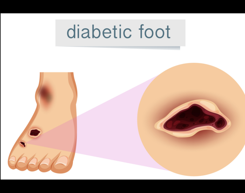 Alkem Laboratories Ltd. to launch State of the Art Technology for Diabetic Foot Ulcer Management for the first time in India