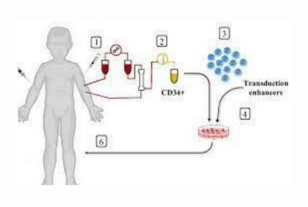 Gene therapy for hemoglobinopathies