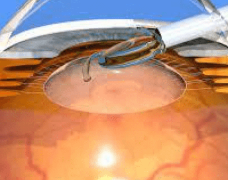 A New Ray Of Hope For Cataract Patients_featured image