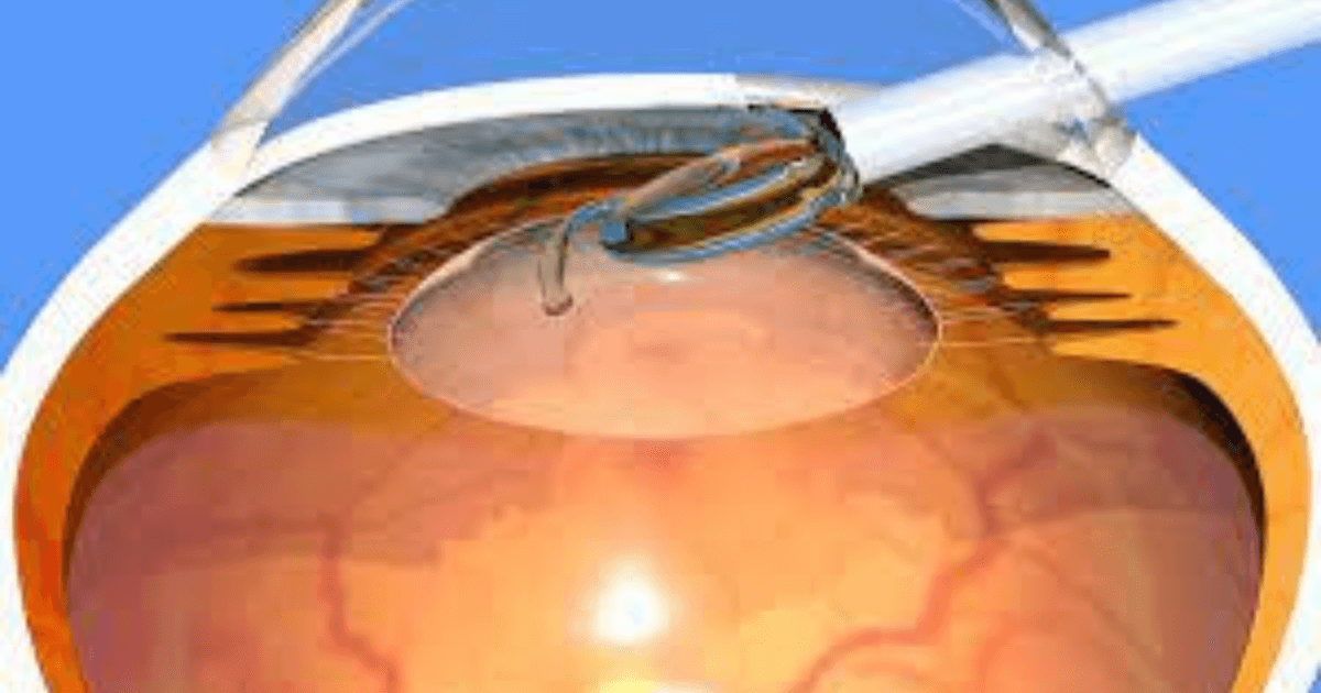 A New Ray Of Hope For Cataract Patients