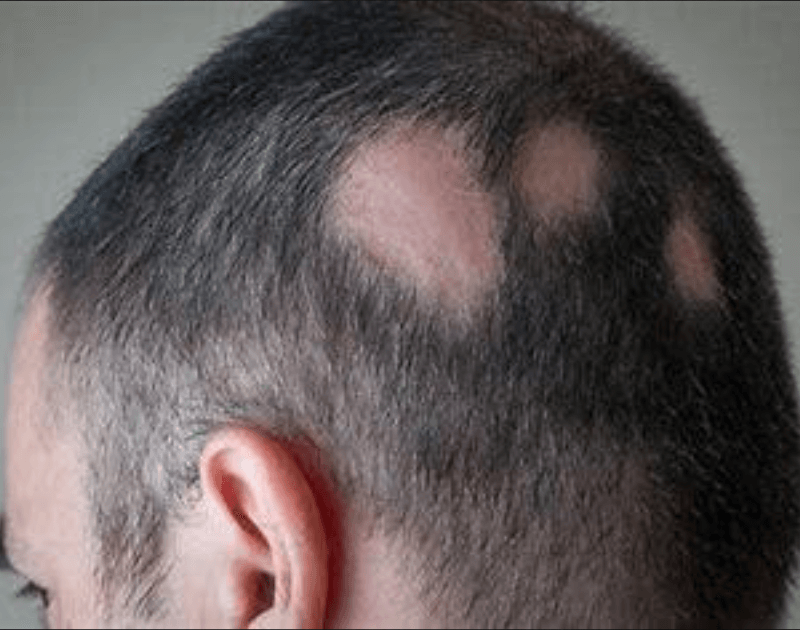 A Promising Oral Drug For Severe Alopecia