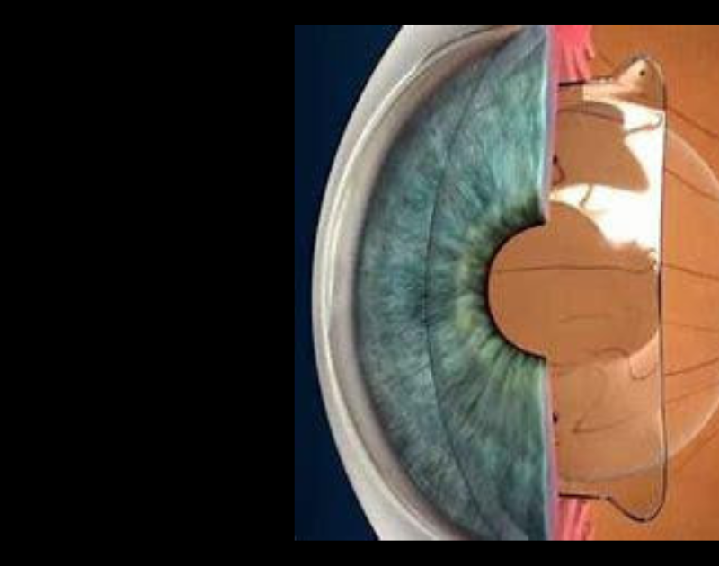 Perks Of Lenses And Laser Surgery Combined For Better Opthalmic Outcome_featured image