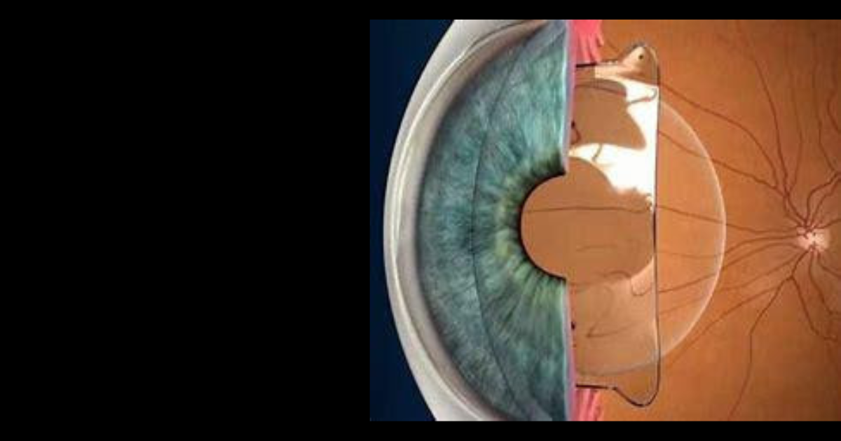 Perks Of Lenses And Laser Surgery Combined For Better Opthalmic Outcome