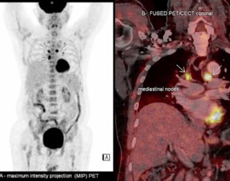 Good’s Syndrome, a lesser known Immunodeficiency disorder