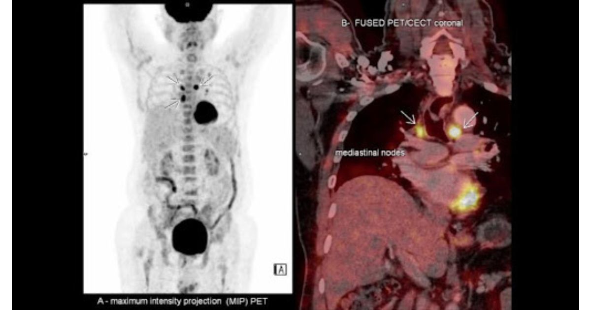 Good’s Syndrome, a lesser known Immunodeficiency disorder