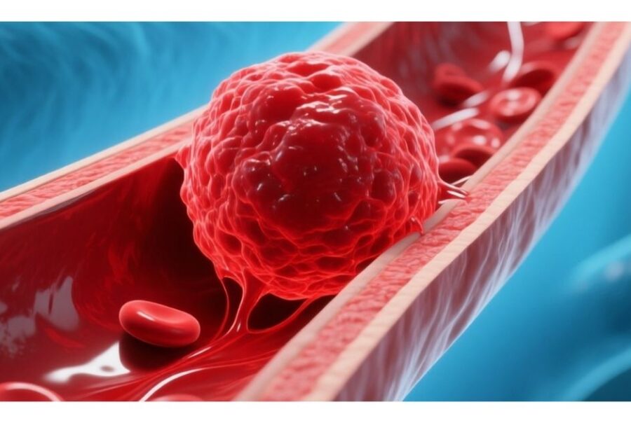 Thrombosis The Silent Clot Threat That’s Still Making Headlines